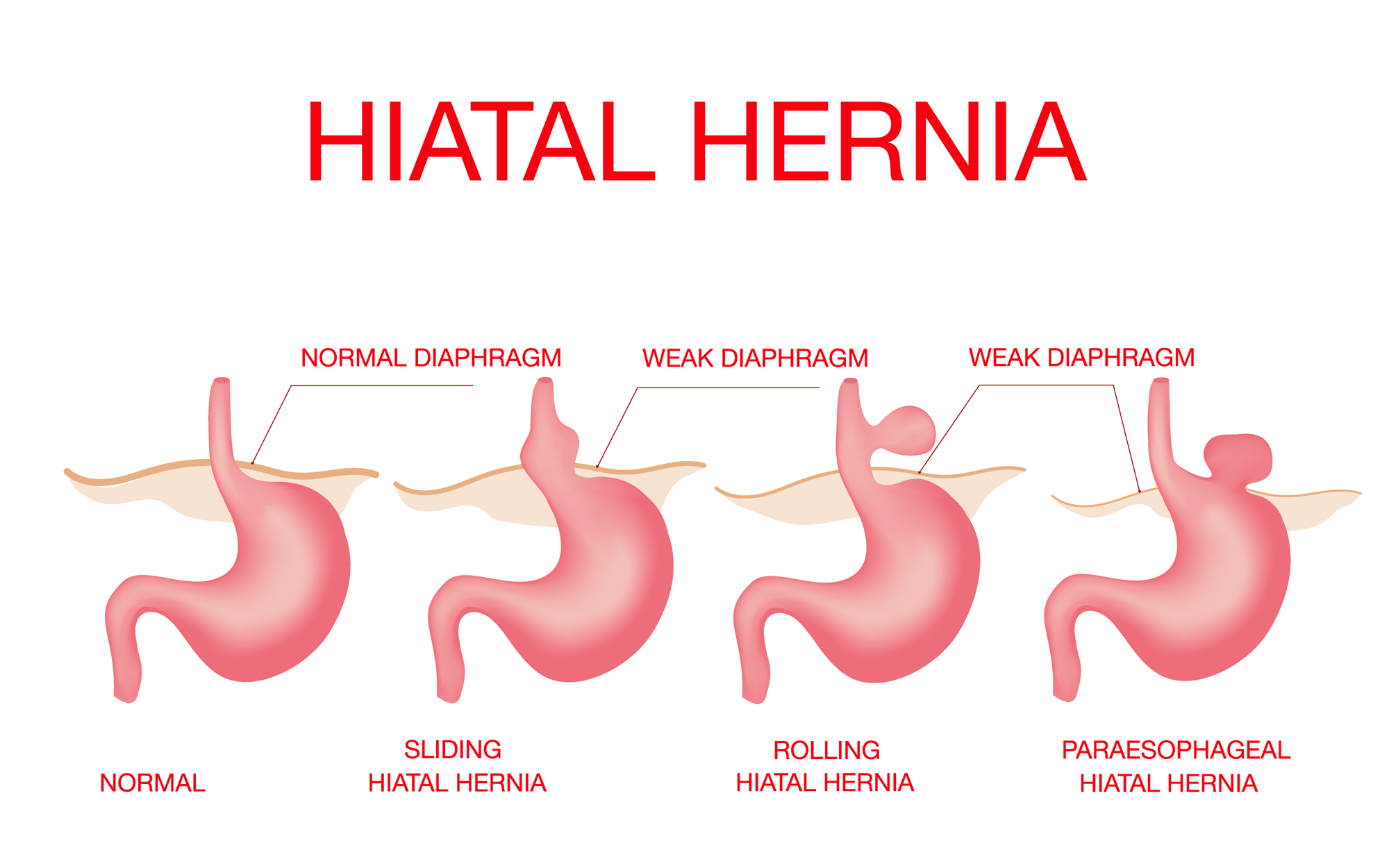 hiatal-hernia-types